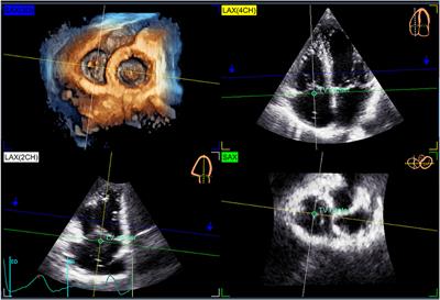 Reference ranges of tricuspid annulus geometry in healthy adults using a dedicated three-dimensional echocardiography software package